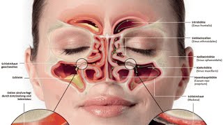 Chronische Sinusitis maxillaris [upl. by Geier]