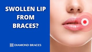 Why Is My Lip Swollen from Braces [upl. by Snyder]