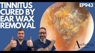 TINNITUS CURED BY EAR WAX REMOVAL  EP943 [upl. by Agustin740]