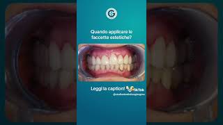 Prima e dopo  Faccette dentali [upl. by Euqimod]