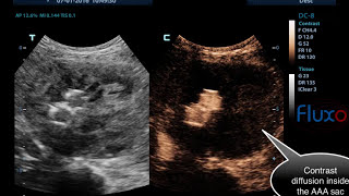 Endoleak type II  CEUS  Contrast Enhanced ultrasound [upl. by Ahtrim]