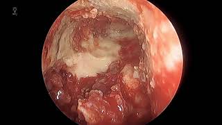 Frontal sinus drill out Draf III  endoscopic modified lothrop for severe frontal sinusitis [upl. by Filiano]