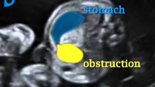 Fetal Medicine Foundation  Duodenal stenosis [upl. by Intyre676]