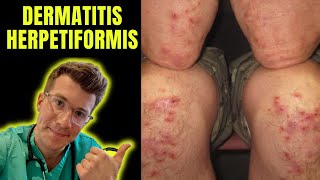 Dermatitis Herpetiformis rash seen in Coeliac Disease aka gluten intolerance explained [upl. by Idham]