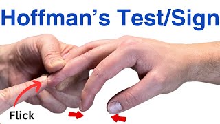 How to Perform a Hoffmans Test  Inverted Supinator Sign  Clonus  Hyperreflexia [upl. by Madalyn]