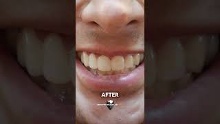 The BEST Accessories for Your Smile  Snap On Veneers [upl. by Eelrefinnej]