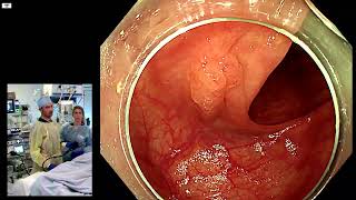 Characterization and resection of a recurrence of a SSL sessile serrated lesion in the colon [upl. by Nahtnahoj394]