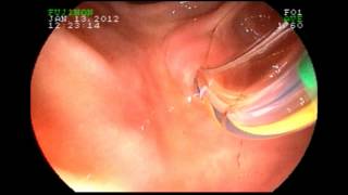 Biliary Manometry  Sphincter of Oddi [upl. by Rotkiv131]