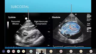 21 04 13 Pericardiocentesis lecture [upl. by Akenom]