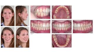 Maxillary molar mesialization with the use of palatal [upl. by Nohshan]