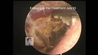 Completely blocked ear cleaning 20230715 [upl. by Lleksah]