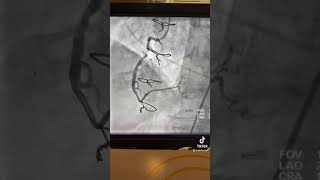 A Shockwave Lithotripsy C2 IVL Complex case of a tortuous RCA DrHamo [upl. by Ayomat]