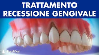 Gengive ritirate  Trattamento recessione gengivale © [upl. by Cyn]