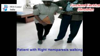 Gait Training with FES System Functional Electrical Stimulation for hemiplegic gait  stroke [upl. by Ainex]