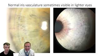 Treatment of narrow angles Laser Peripheral Iridotomy with hemorrhage [upl. by Arratoon]