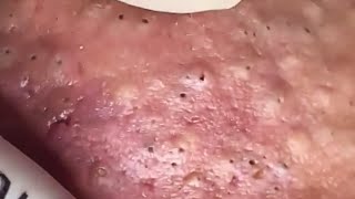 Blackheads amp Whiteheads Satisfying Removal 0275 [upl. by Elly69]