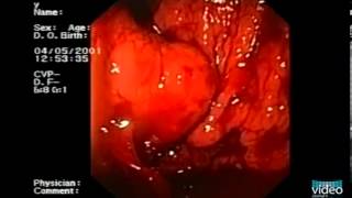 Endotherapy of Gastric Fundal Varices IntraVariceal Injection of NButyl2Cyanoacrylate [upl. by Yeca]