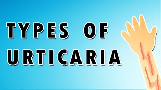 Urticaria Symptoms Treatment and Causes [upl. by Mattox]