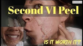 Second Chemical Peel Process  VI peel 2 More results IS IT WORTH IT [upl. by Patsy]