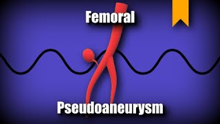 Femoral Pseudoaneurysm [upl. by Eidson]