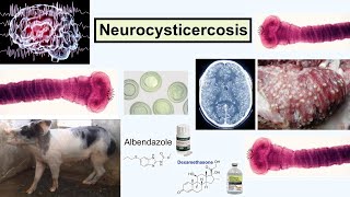 neurocysticercosis [upl. by Sum784]