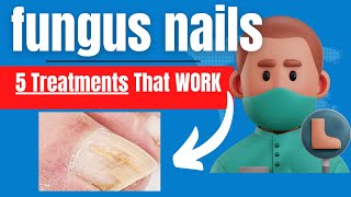 5 Fungus Toenail Treatments That Work [upl. by Gideon358]