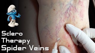 Sclerotherapy Procedure  quotSpider Veins amp Varicose Veinsquot [upl. by Nosna497]