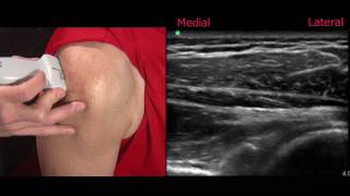 Ultrasound of the Shoulder [upl. by Cecilla]