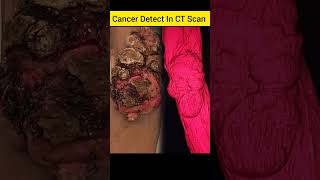 Cancer Detect In CT Scan [upl. by Doe]