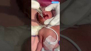 Et Tube Insertion medical nicu newbornbaby [upl. by Slaohcin]