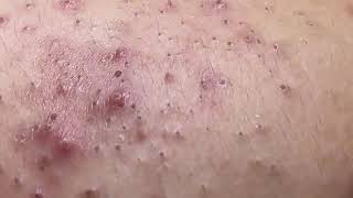 Huge blackhead removal from nose old aged blackheads removal  blackheads new this week 2023 6 [upl. by Keram]