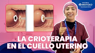 La crioterapia en el cuello uterino [upl. by Nwahshar]