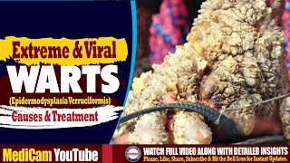 Shocking Extreme Viral Warts  Causes And Treatment [upl. by Machute]