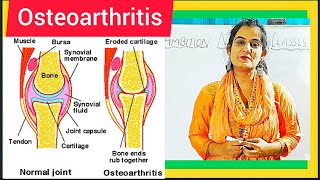 Osteoarthritis  Causes Symptoms Treatment Diagnosis Medical Surgical amp Nursing Management [upl. by Edwina279]