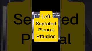 Septated Pleural Effusion  Lung Fluid  Dyspnoea ultrasound [upl. by Foscalina]