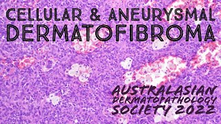 Cellular Dermatofibroma amp Aneurysmal Dermatofibroma 101 pathology dermpath dermatology [upl. by Ayres]