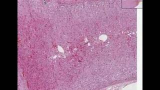 Histopathology AdrenalCortical adenoma [upl. by Sancha]