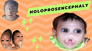 Holoprosencephaly  Causes  Symptoms  Diagnoses and Treatement [upl. by Eednus950]