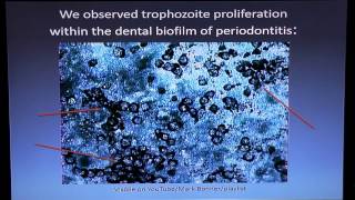 Cure Periodontitis Antiparasitic and Microscopic Method Dr Bonner [upl. by Ynehpets]