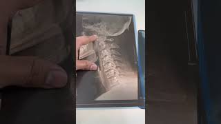 Cervical spondylosis treatment with chiropractic adjustment before and after [upl. by Trevar957]