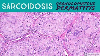 Sarcoidosis amp Granulomatous Dermatitis Pattern  Inflammatory Dermatopathology Basics [upl. by Noired558]