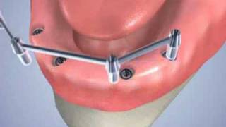 pose de 4 implants dentaires avec une barre dattachement [upl. by Corneille]