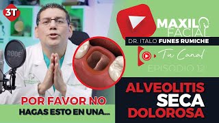 ⛔¡POR FAVOR NO HAGAS ESTO EN UNA ⇨ ALVEOLITIS SECA DOLOROSA [upl. by Mungo]