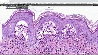 Dermatitis herpetiformis Phillip H McKee Antonina Kalmykova CSD Health Care [upl. by Relyt766]