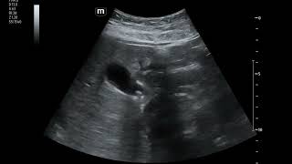 Episodes of EpigastricRUQ Abdominal Pain in 17 yo Female [upl. by Aihsi]