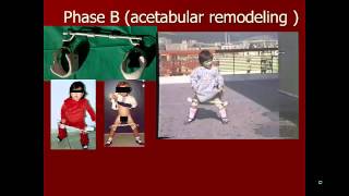 Educational video for the treatment of developmental dysplasia of hip without surgery [upl. by Deeyn810]