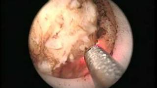 Endoscopic Vaporesection Of The Prostate Using The Continuous Wave 2 µm Thulium Laser [upl. by Howlyn]