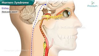 Horners Syndrome  Etiology  Classification  Diagnosis  Treatment [upl. by Marx]