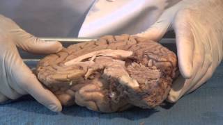 The Ventricles Neuroanatomy Video Lab  Brain Dissections [upl. by Seligmann]