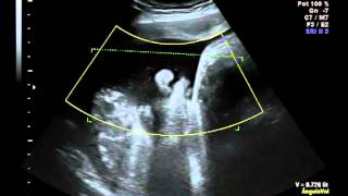 Ecografía Obstétrica 4D  Dexeus Mujer [upl. by Nayarb]